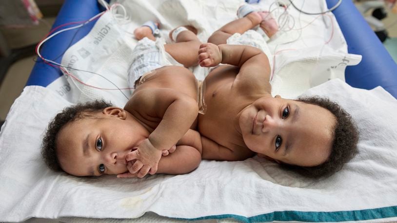 This photo provided by the Children’s Hospital of Philadelphia shows conjoined twins, Amari and Javar Ruffin, at the Children’s Hospital of Philadelphia, March 20, 2024. (Ed Cunicelli/Children’s Hospital of Philadelphia via AP)