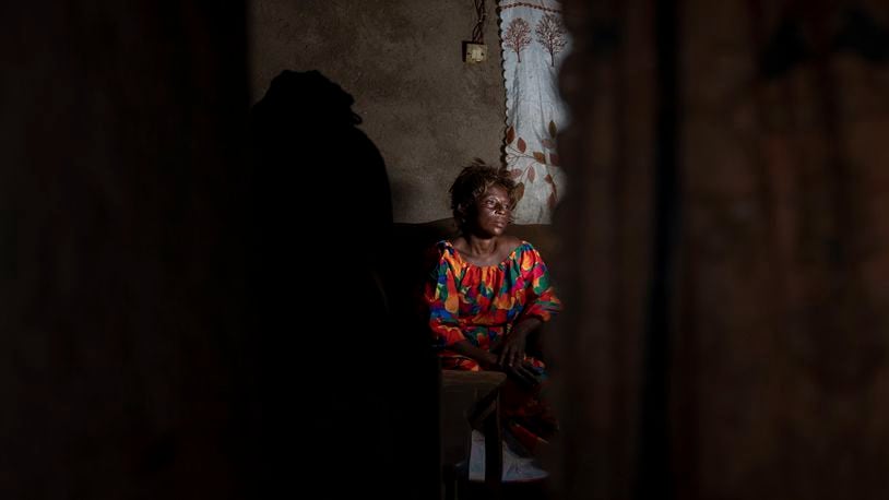 Sifa Kunguja, a 40-year-old sex worker, sits home after recovering from mpox Wednesday, Sept. 4, 2024 in Kamituga, eastern Congo. (AP Photo/Moses Sawasawa)