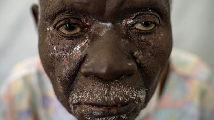 Christophe Chavilinga, suffering from mpox, waits for treatment at a clinic in Munigi, Congo, Aug. 16, 2024. The World Health Organization declared the ongoing outbreaks of mpox in Congo and elsewhere in Africa to be a global emergency. (AP Photo/Moses Sawasawa)