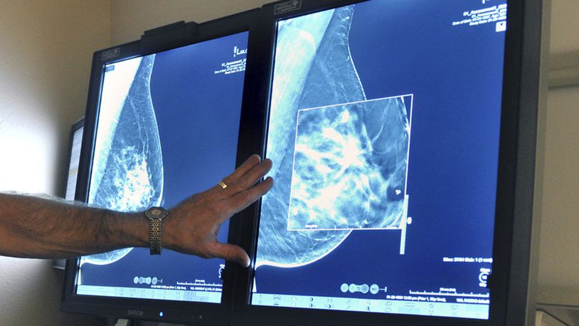 Breast cancer is the most common cancer in women, after non-melanoma skin cancer. (Torin Halsey/Times Record News via AP, File)