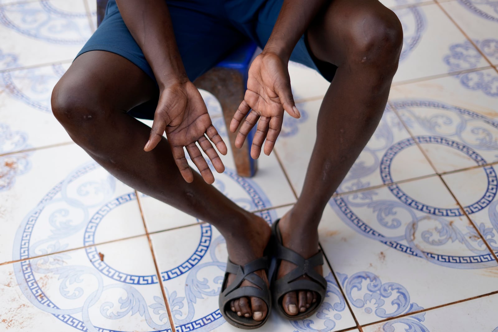 A miner, who spoke on condition of anonymity out of fear of reprisals, shows bruises on his hands that he got while climbing out of the mine, during an interview with The Associated Press, in Stilfontein, South Africa, Wednesday, Jan. 15, 2025. (AP Photo/Themba Hadebe)