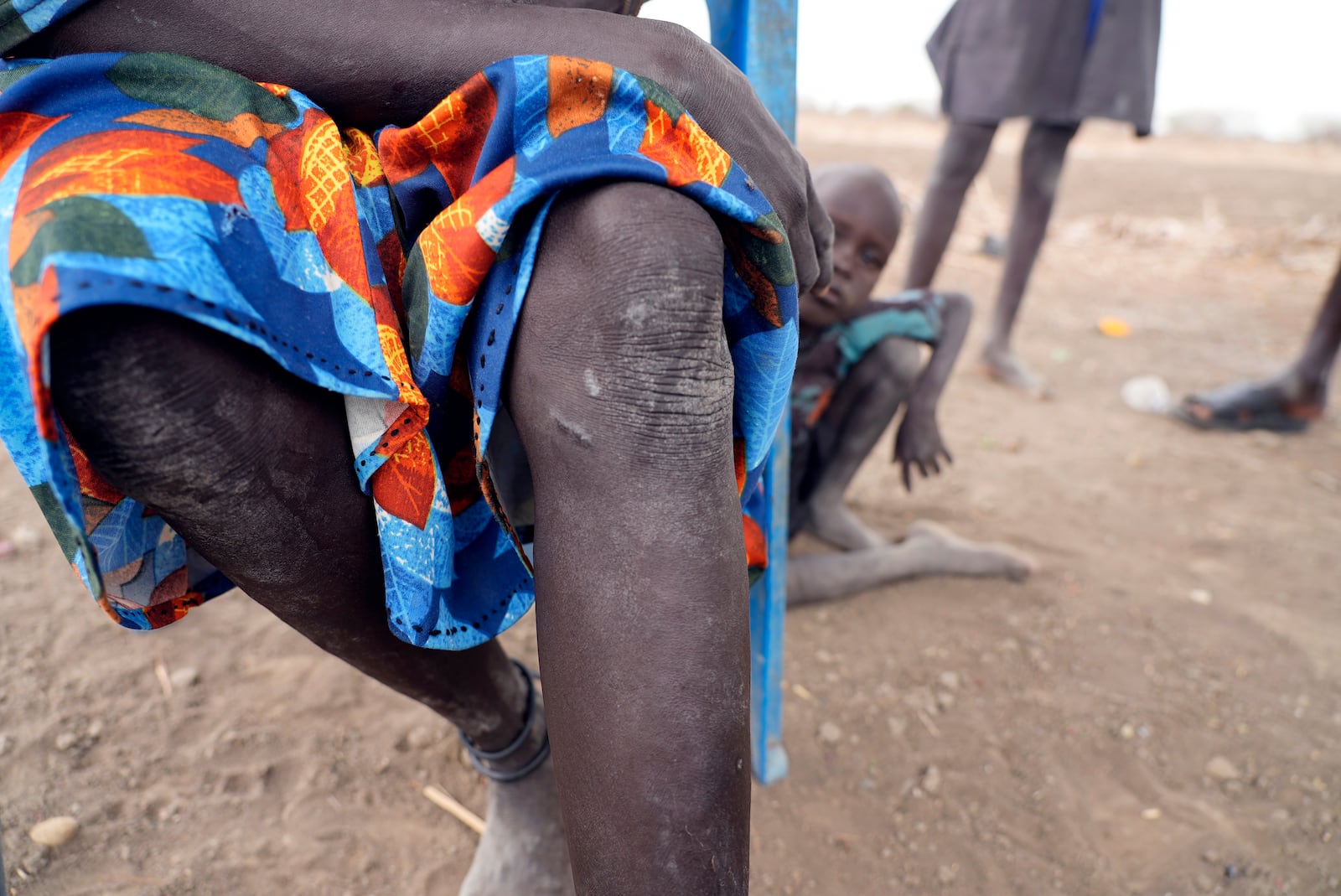 Nyingong Aguek, who contracted Guinea worm after she and her two sons drank swampy water while traveling in 2022, shows her legs where four worms had emerged from her left leg leaving scars in Jarweng, South Sudan, May 13, 2023. (AP Photo/Sam Mednick)