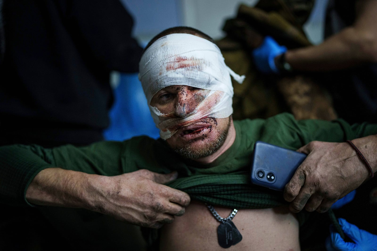 An injured Ukrainian serviceman takes off his shirt after arriving from the battlefield at Medical Service "Ulf" of the 108th Separate Battalion "Da Vinci Wolves" on Pokrovsk direction, Ukraine, Monday, Dec. 23, 2024. (AP Photo/Evgeniy Maloletka)