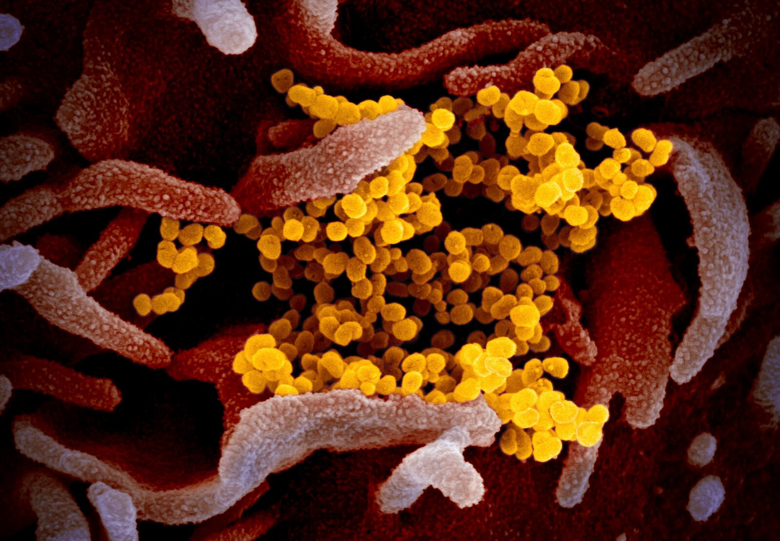 FILE - This undated electron microscope image made available by the U.S. National Institutes of Health in February 2020 shows the Novel Coronavirus SARS-CoV-2, yellow, emerging from the surface of cells, pink, cultured in the lab. Also known as 2019-nCoV, the virus causes COVID-19. The sample was isolated from a patient in the U.S. (NIAID-RML via AP, File)