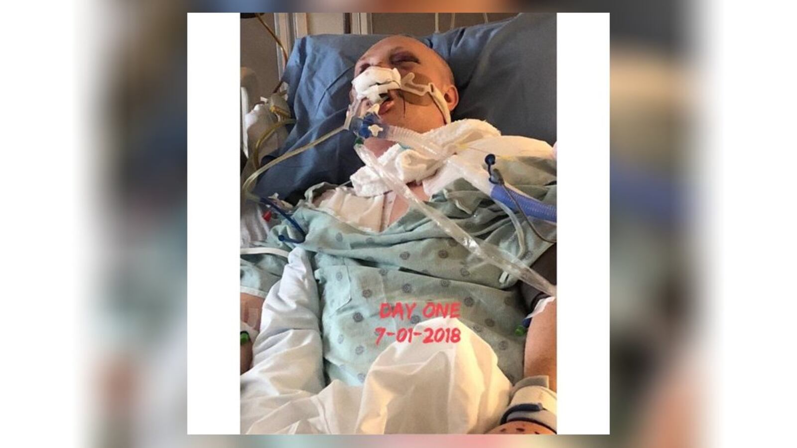 This is the way Nate Ellen, 26, looked in the Alabama hospital hours after he was struck by a car. He suffered traumatic brain damage and other serious injuries. 